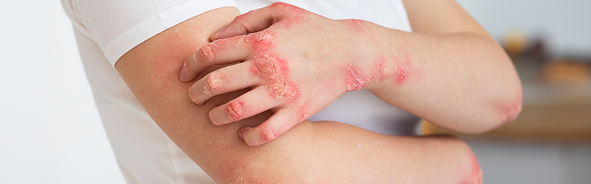 Psoriasis